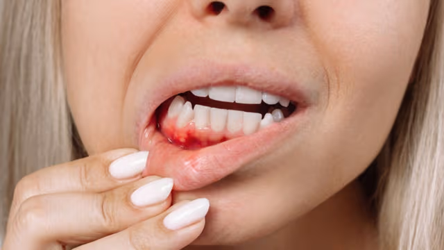 Mẹ bầu bị viêm lợi phải làm sao và cách xử lý an toàn, dứt điểm