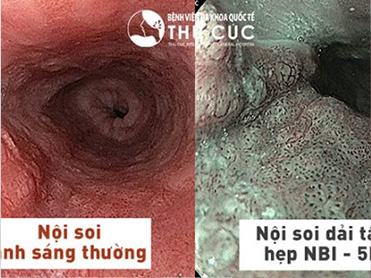Chế độ ánh sáng dải tần hẹp giúp quan sát sâu và sắc nét: