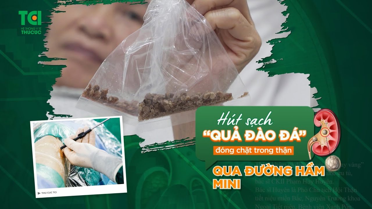 Hút sạch “quả đào đá” đóng chặt trong thận qua đường hầm mini